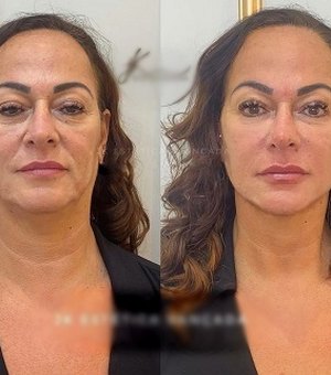 Nadine Gonçalves, mãe de Neymar, surpreende internautas com harmonização facial