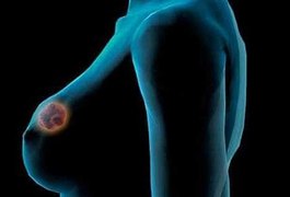 Saiba quais os riscos da quimioterapia tardia no tratamento do câncer de mama