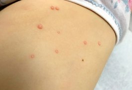 Molusco contagioso: atenção para o vírus de fácil transmissão e comum em crianças