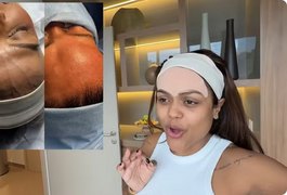 Influenciadora Camila Loures retira 'veia saltada' na testa; procedimento carece de respaldo científico