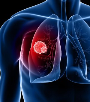 Nova vacina contra câncer de pulmão apresenta resultados promissores