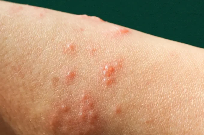 Mpox: nova recombinação de cepas é identificada pela OMS