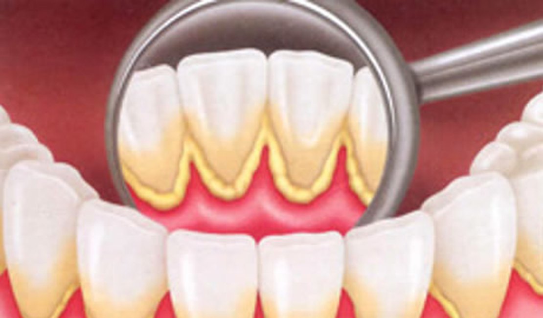 Saiba o que é e como evitar o 'Cálculo dental'