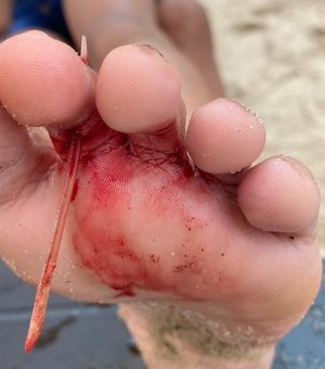Criança é socorrida após pisar em ferrão de arraia em praia de Maceió