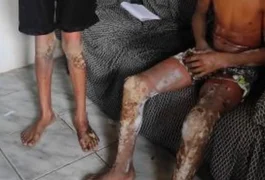 Jovem que teve 60% do corpo queimado em acidente com fogos de artifício é transferido para Maceió