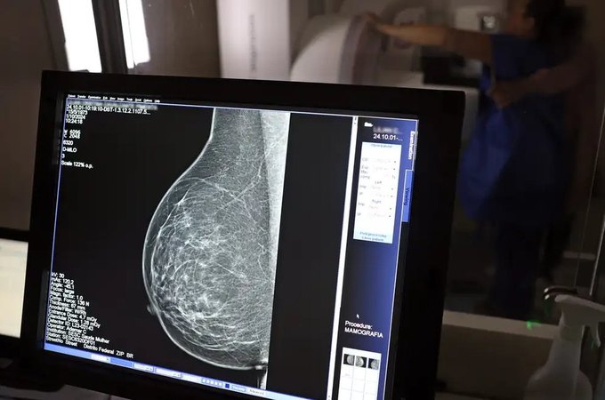 Ministério da Saúde passa a recomendar mamografia a partir dos 40 anos