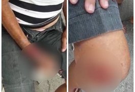 Idosa de 82 anos é atropelada duas vezes seguidas e fica ferida em Maceió