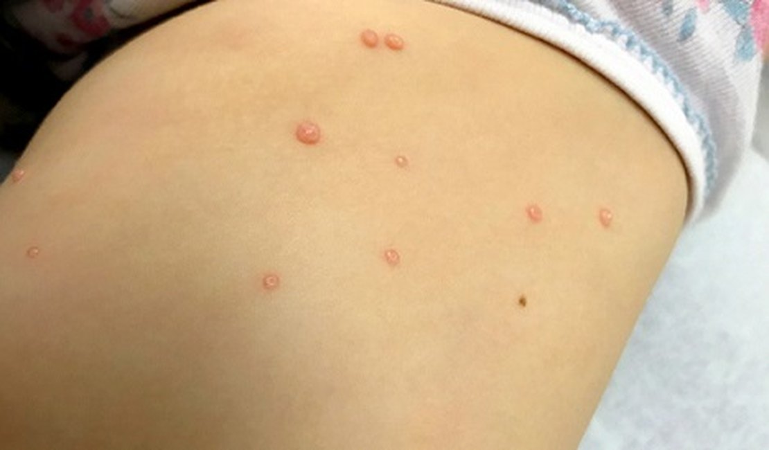 Molusco contagioso: atenção para o vírus de fácil transmissão e comum em crianças