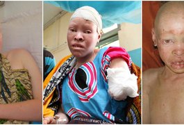 Albinos são cruelmente mutilados e partes do corpo são usadas em 'poções mágicas'