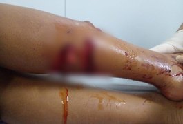 Ataque de cão deixa duas crianças feridas no interior de Alagoas