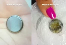 Menino de 6 anos é internado após engolir pilha-botão após desafio com a irmã, em Maceió