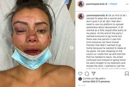 Modelo do 'De Férias com o Ex' é agredida durante festa em casa