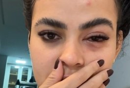 Mulher tem infecção no olho causada por mosca de banheiro