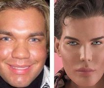 Após bactéria, Ken Humano passará por nova cirurgia de reconstrução no nariz