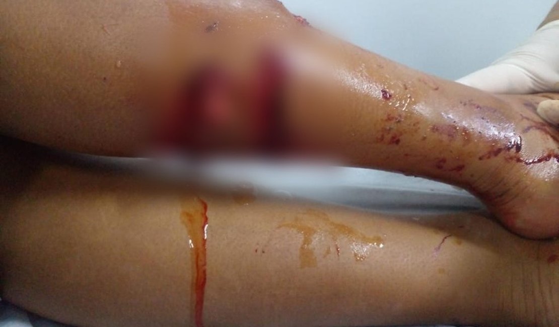 Ataque de cão deixa duas crianças feridas no interior de Alagoas