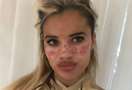 Ex-Big Brother é hospitalizada após seguir dica de beleza do TikTok