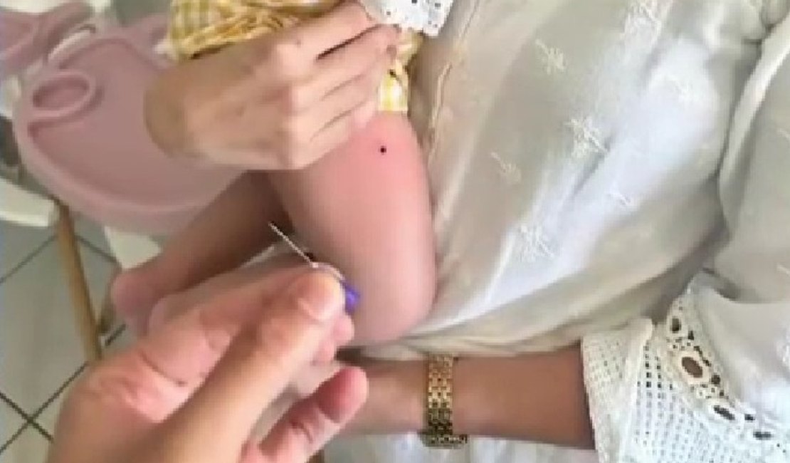 Agulha é deixada na perna de criança durante vacinação em Maceió