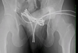 Estudante introduz cabo USB no pênis e precisa de cirurgia para retirada do objeto