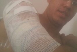 Celular explode debaixo de travesseiro e estudante de medicina tem queimaduras de 2º grau