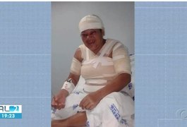 Mulher queimada com ácido pelo ex-companheiro em Marechal recebe alta hospitalar