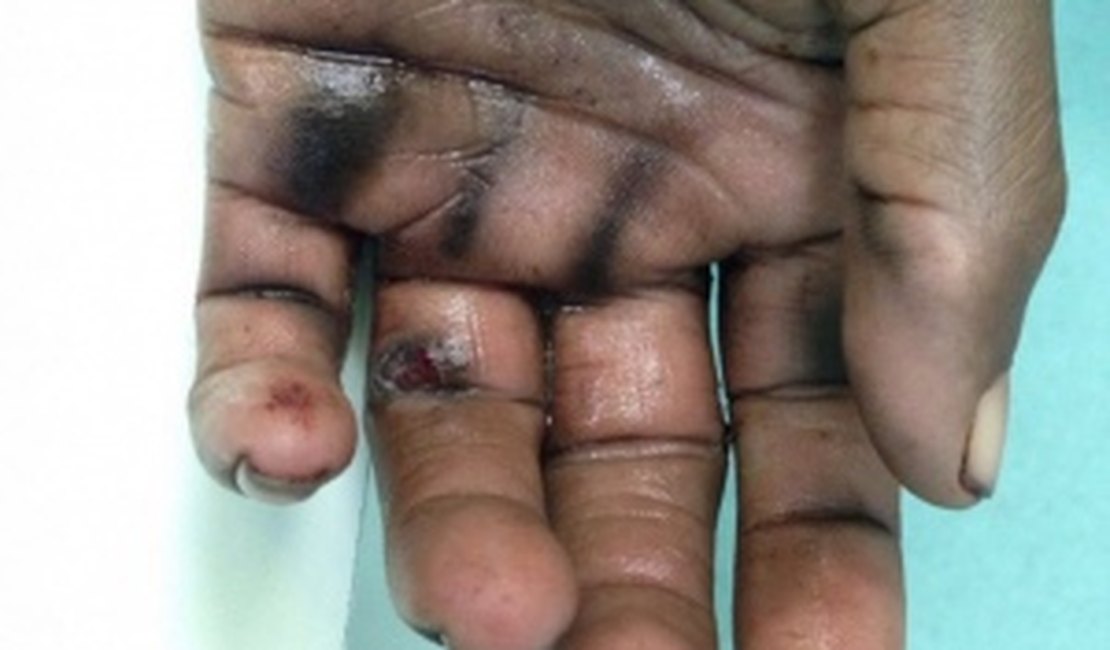 Celular explode e deixa homem gravemente ferido em Maceió