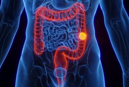 SUS adota novo exame para detectar câncer de intestino antes dos sintomas
