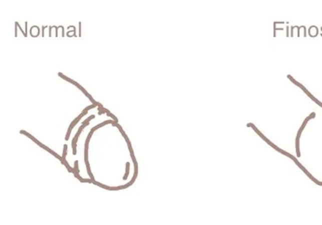 Você tem fimose? O que é a condição que transforma o sexo em agonia para milhares de homens
