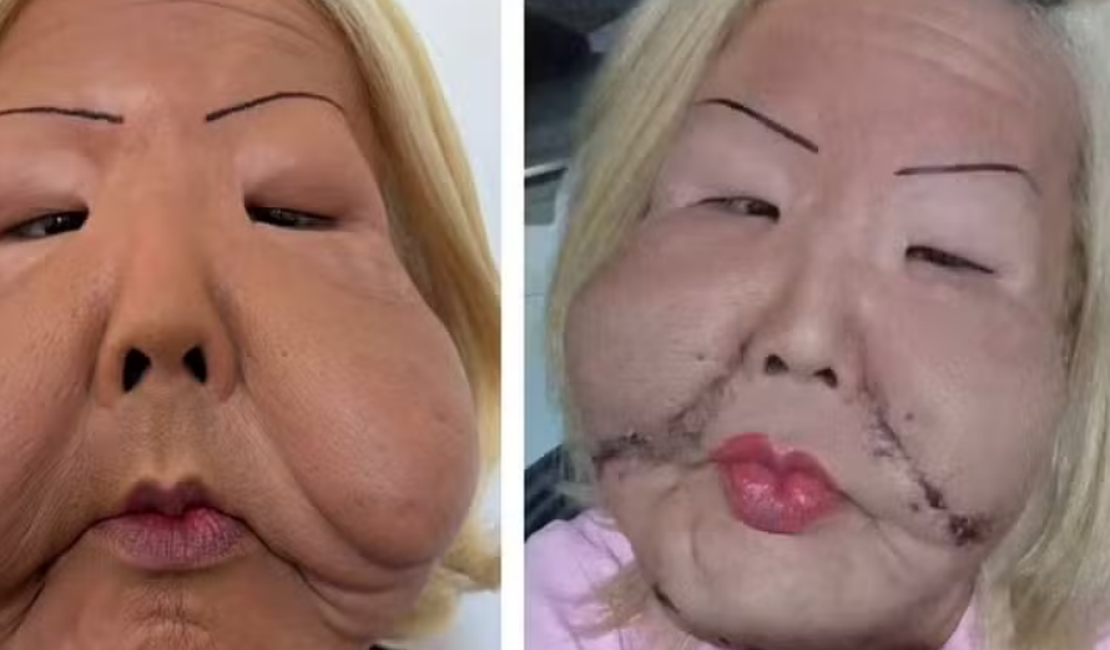 Veja o antes e depois do rosto da Juju do Pix após primeira cirurgia de reconstituição facial