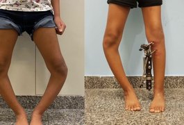 Técnica inovadora corrige deformidades nas pernas de crianças e jovens