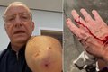 Jornalista da Globo é atacado por pitbull sem guia