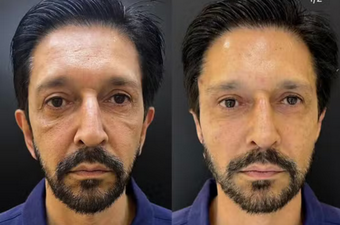 Ricardo Nunes faz harmonização facial, clínica de estética publica 'antes e depois', mas apaga post