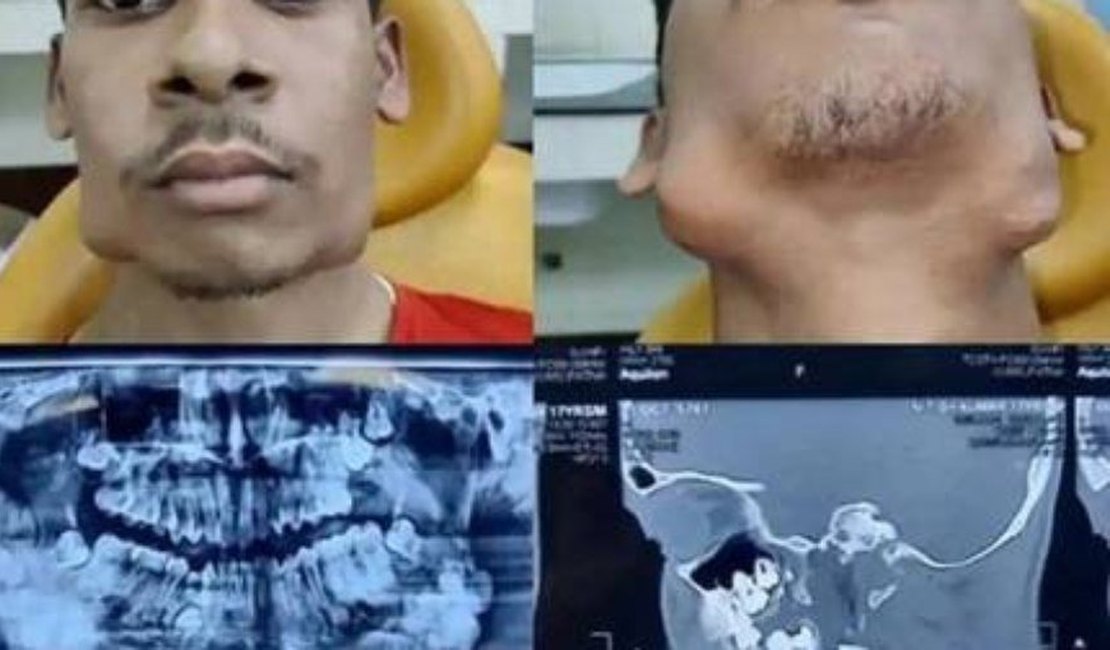 Jovem de 17 anos faz cirurgia para retirar 82 dentes extras