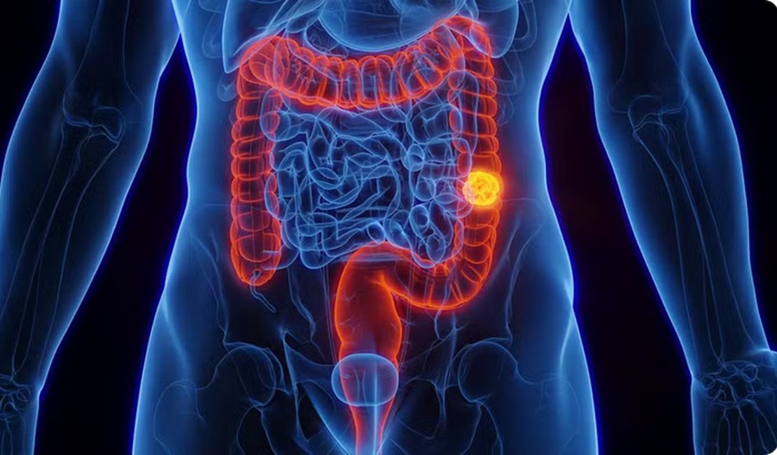 SUS adota novo exame para detectar câncer de intestino antes dos sintomas