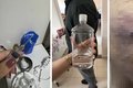 Dentista é suspensa em Arapiraca após aplicar silicone industrial em procedimentos estéticos, diz CRO-AL