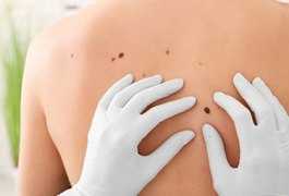 Dia Global alerta para prevenção e diagnóstico precoce do câncer de pele não melanoma