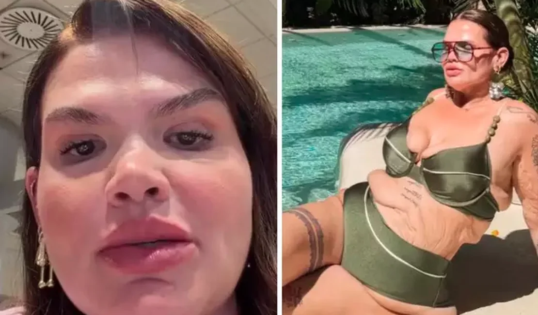 Thais Carla se prepara para cirurgia de remoção de pele após perder 120 kg