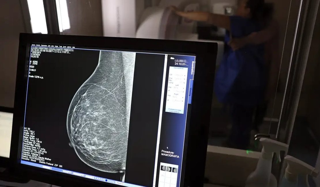 Ministério da Saúde passa a recomendar mamografia a partir dos 40 anos