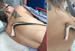 Banhista fica com ferrão de arraia cravado nas costas após entrar no mar da Flórida