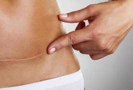 Pesquisa aponta que cesárea aumenta risco de câncer de placenta após mola gestacional