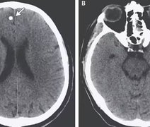 Mulheres comem ovos de tênia comprados na dark web para perder peso; veja o que isso faz com cérebro
