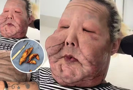 Juju do Pix passa por nova cirurgia, e médico mostra óleo mineral enrijecido retirado dela