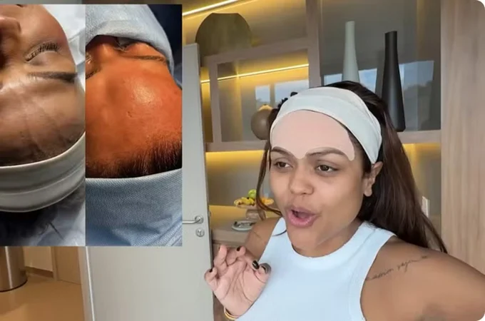 Influenciadora Camila Loures retira 'veia saltada' na testa; procedimento carece de respaldo científico