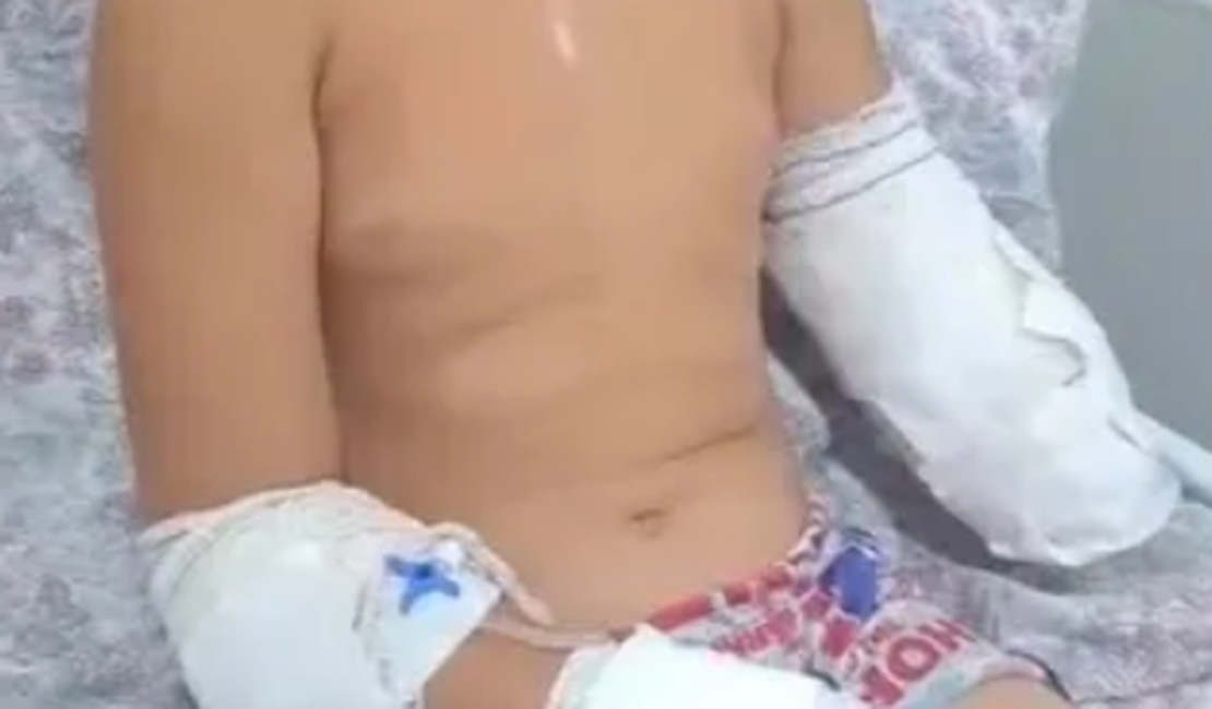 Menino de 10 anos tem parte de braço amputado após acidente em Maribondo