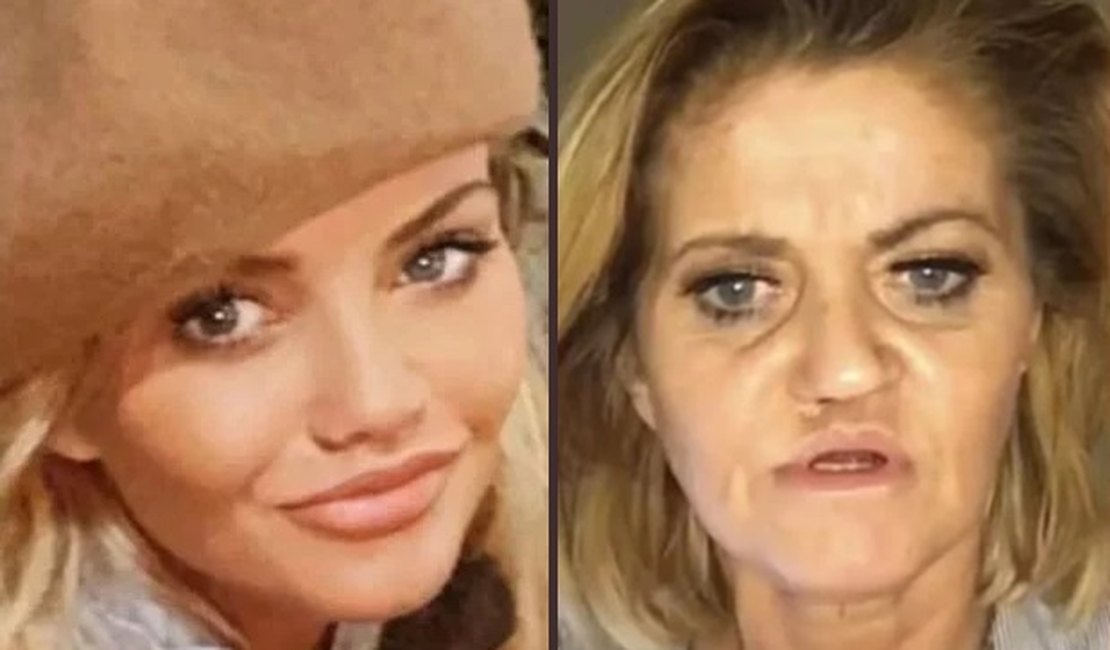 Consumo excessivo de cocaína corrói o rosto de atriz, que choca seguidores após cirurgias