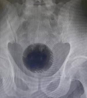Homem passa por cirurgia para retirar bola de 7 cm presa no ânus