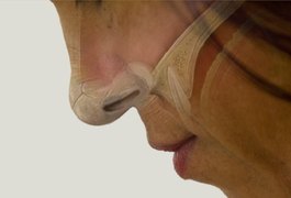Cirurgia pioneira trata pacientes com perda de olfato causada pela covid-19