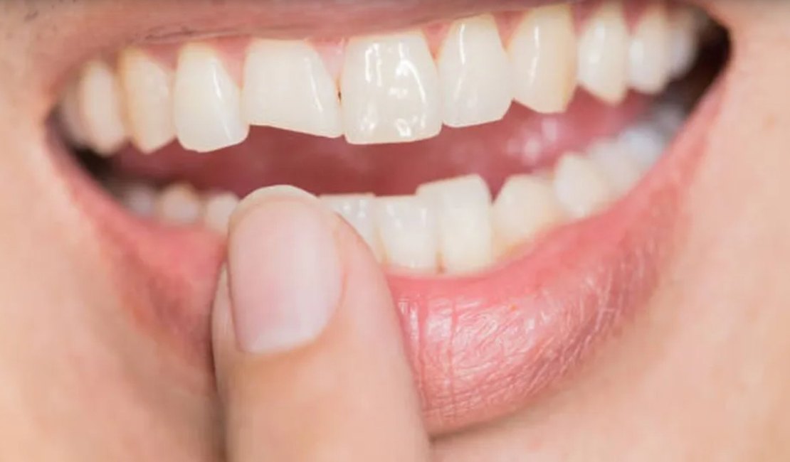 Quebrou o dente? O que fazer nos primeiros minutos para salvar o sorriso?