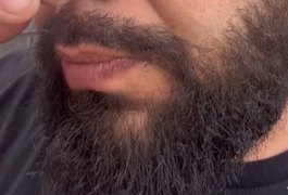 Cantor sertanejo mostra como ficou seu rosto após ser queimado em show