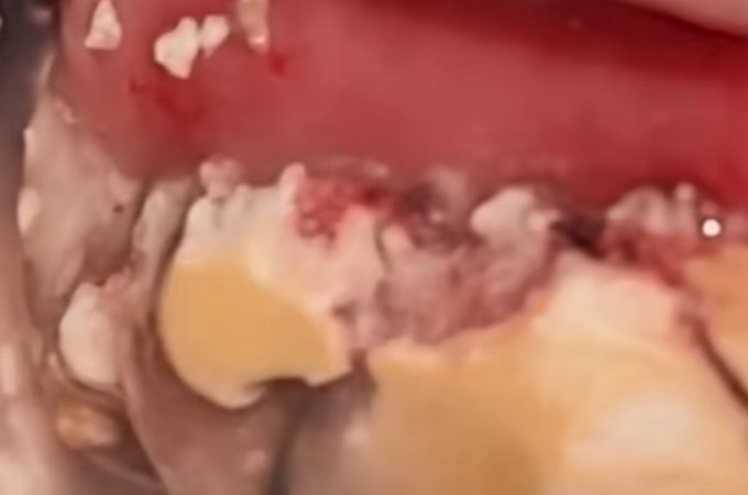 Vídeo impressionante mostra placa gigante de tártaro sendo removida da boca de paciente