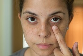 Livre-se das olheiras com esta receitinha caseira; saiba